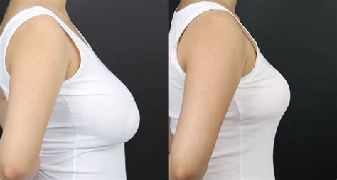 Breast Reduction In South Korea Cosmetic Surgery Tips