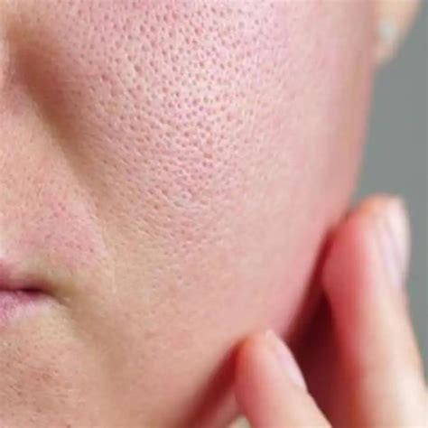 Open Pores Treatment By Dermatologist In Delhi Derma Arts