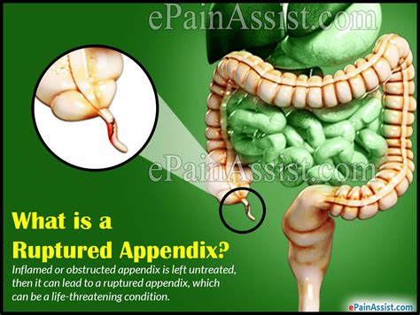 Ruptured Appendixcausessymptomstreatmentsignscomplications