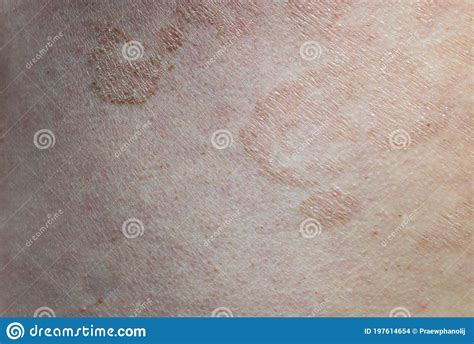 Close Up Skin Disease Tinea Versicolorpityriasis Versicolor Stock