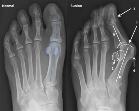 Bunion Treatment Foot Injury Treatment Nj Seaview Orthopaedics