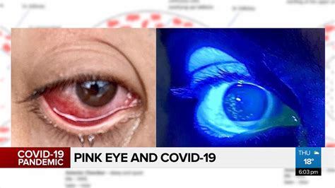 Pink Eye A Less Common Symptom Of Covid 19 Video Citynews Edmonton