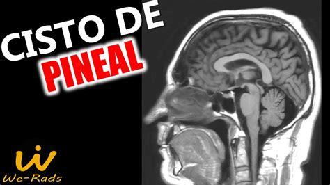 Cisto Pineal 1 Cm E Perigoso