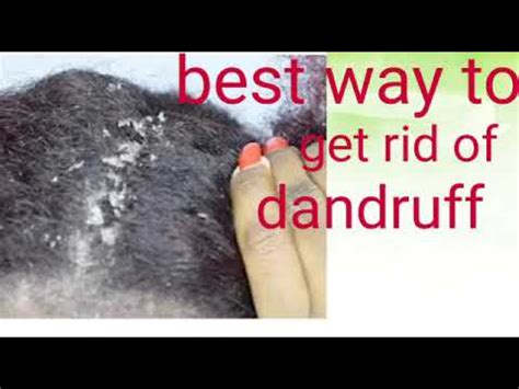 If you want to dye your hair purple, you may need. Best way to get rid of dandruff - YouTube