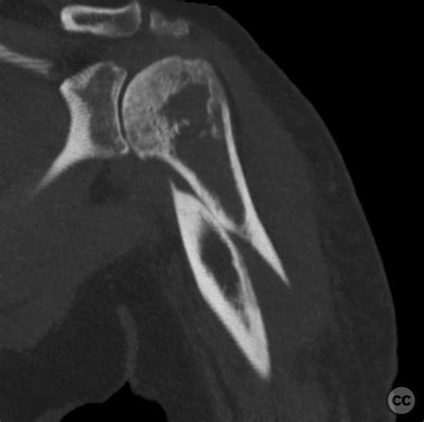 Prox Humeral Shaft Fracture With Concomitant Gh Osteoarthritis