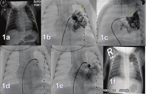 A Chest X Ray Showing Lobulated Opacity In The Left Mid Zone Arrow