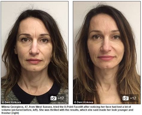 Look 10 Years Younger In Just 30 Minutes The Non Surgical 8 Point