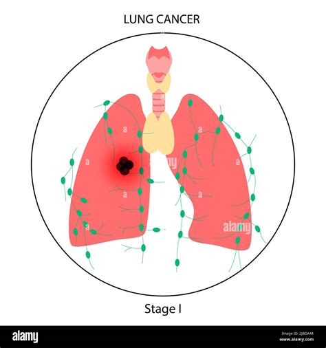Lungs Cancer Illustration Stock Photo Alamy
