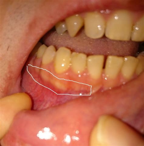 Strange White Line On Gums Dentistry
