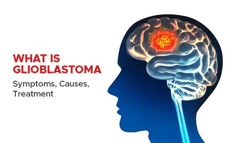 What Is Glioblastoma Symptoms Causes Treatment Psri Hospital
