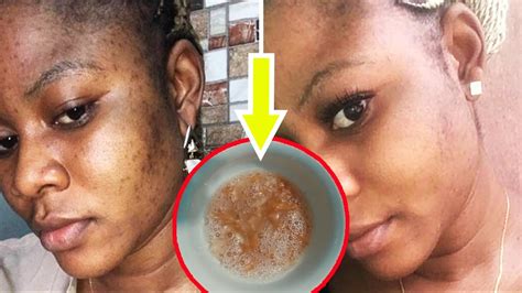 How To Remove Only 1 Day Dark Spots From Your Face Best Treatment For