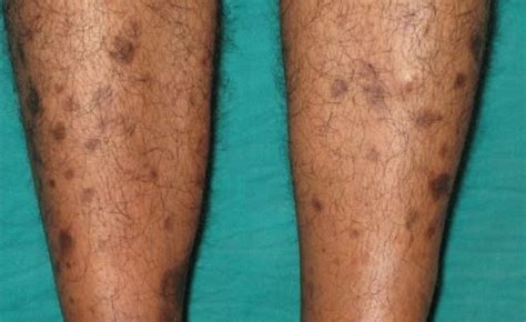 Brown Spots On Legs Spots On Legs Brown Spots On Skin Brown Age Spots