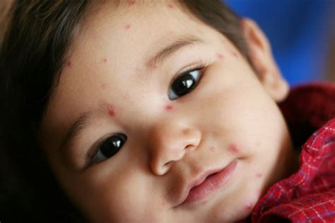 Five Common Skin Problems In Children And How To Treat Them