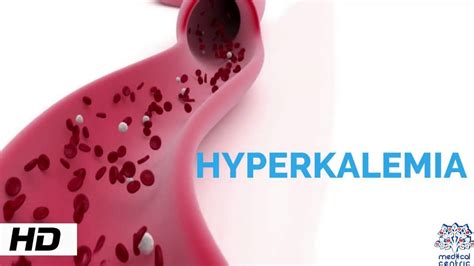 Hyperkalemia Causes Signs And Symptoms Diagnosis And Treatment
