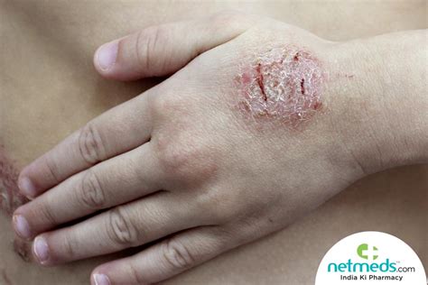 Discoid Eczema Causes Symptoms And Treatment