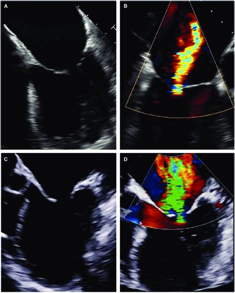 Two Different Entities Of Functional Mitral Regurgitation Fmr A And