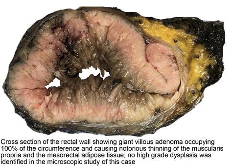 Pathology Outlines Tubulovillous Villous Adenoma