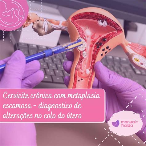 Cervicite Crônica Ativa Com Metaplasia Escamosa Do Epitélio Glandular