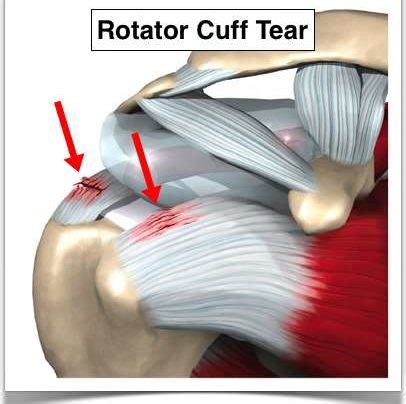 How Do I Know If I Have A Full Thickness Rotator Cuff Tear Updated Howard J Luks MD