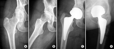 Preoperative And Postoperative Radiographs Of The Right Hip Of A Female