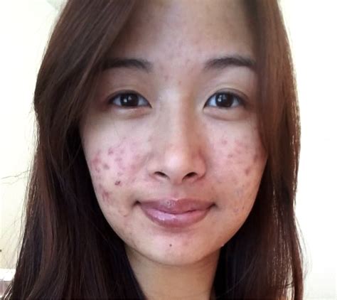 From Fungal Acne Folliculitis To Clear Skin With Pictures Artofit