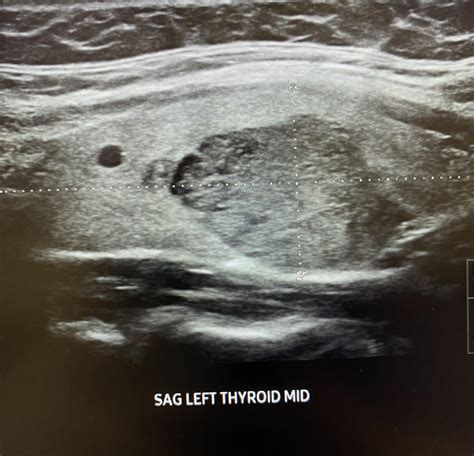 25 Cm Thyroid Nodule Rradiology