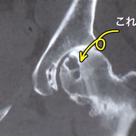 骨嚢胞の中身は | リウマチで変形性股関節症