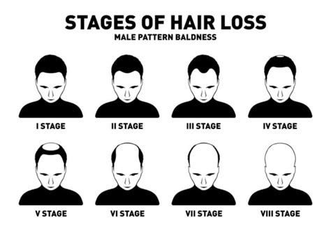 Top 5 Treatments for Male Pattern Baldness in 2022