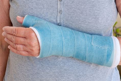 The Truth About Fiberglass Casts For Bone Fractures