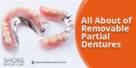 4 Types Of Removable Partial Dentures And Their Advantages Partial