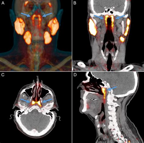 Imaging Reveals New Salivary Glands Can It Help Cancer Patients