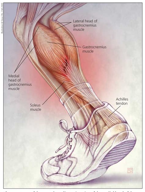 Information from webmd on tendon ruptures, a potentially serious problem that may result in excruciating pain and permanent disability if a tendon is the fibrous tissue that attaches muscle to bone in the human body. Know Your Muscles - Gastrocnemius. - Mending, Coaching & Inspiring Athletes.