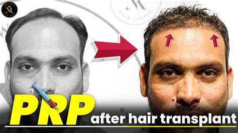 First Prp After Hair Transplant Best Prp In Hyderabad Youtube