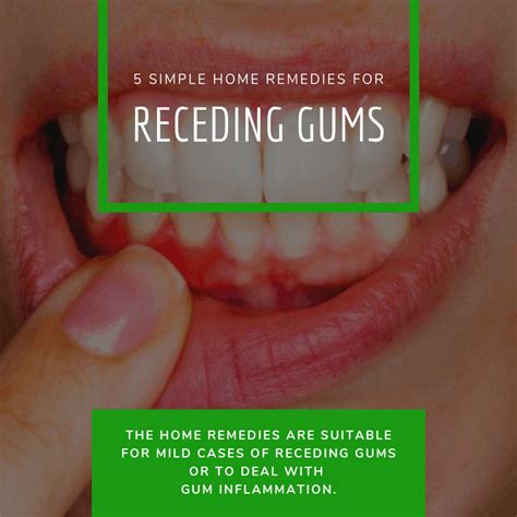 5 Simple Home Remedies For Receding Gums