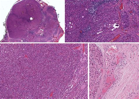 Frontiers Oncocytic Change In Thyroid Pathology