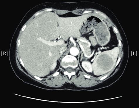 Ct Scan Showing A 47 Cm Solitary Splenic Lesion