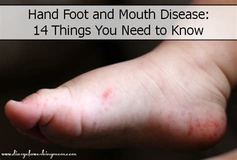 Hand Foot And Mouth Disease 14 Things You Need To Know Diary Of A
