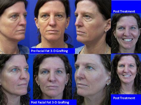 Facial Fat Grafting Dr Walter Tom