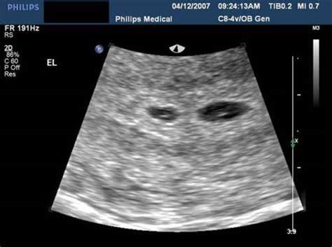 4 weeks pregnant ultrasound twins my xxx hot girl