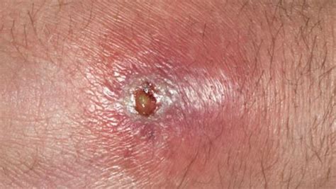 Armpit Boils Causes Symptoms Pictures Small Red Painful Deep Boil