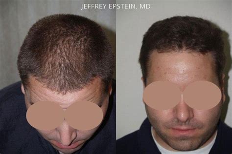 Hair Transplants For Men Photos Miami FL Patient39208