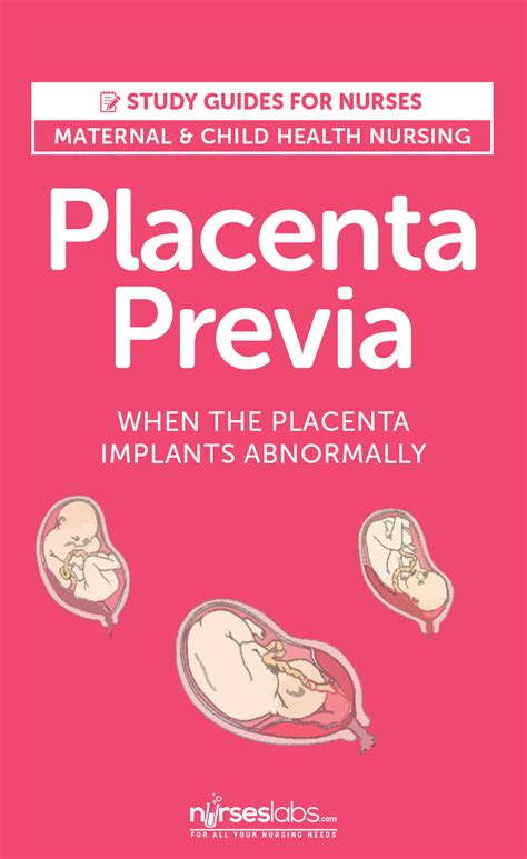 Placenta Previa When The Placenta Implants Abnormally