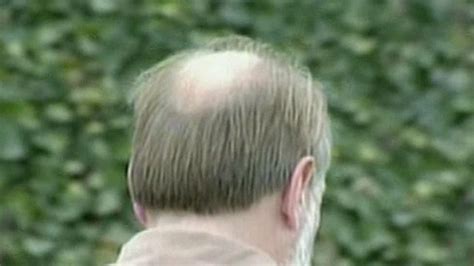 Have Researchers Found A Cure For Balding Fox News