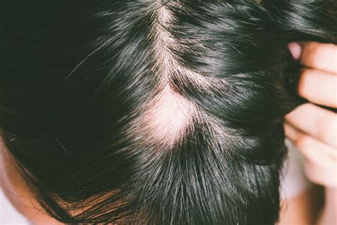 Alopecia What Is It And Can It Be Treated Medical And Cosmetic