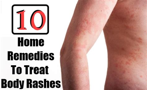 10 Home Remedies To Treat Body Rashes Search Home Remedy