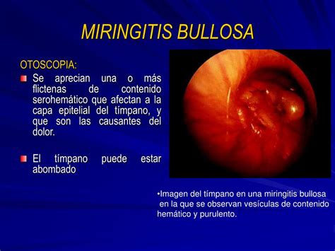 Miringitis
