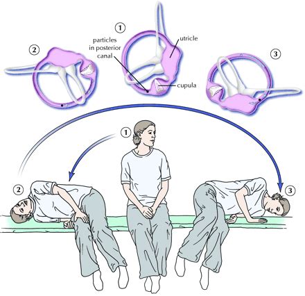 We did not find results for: Benign paroxysmal positional vertigo (BPPV): โรคหินปูนในหู ...