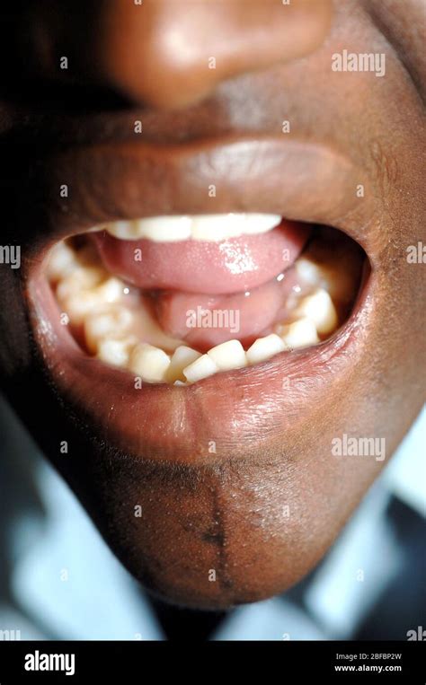 Buccal Mucosa Eumycetoma Situated Under The Patients Tounge Buccal