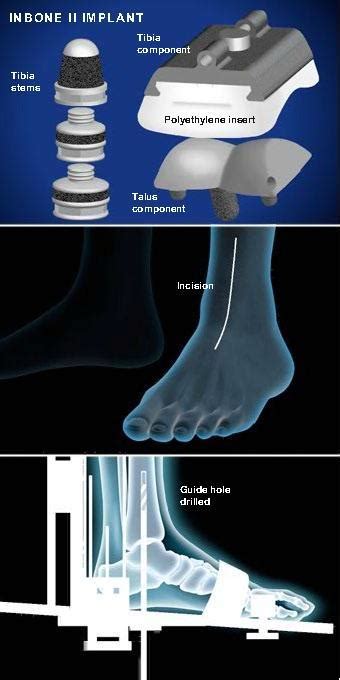 Total Ankle Joint Replacement Wright Inbone® Ii Houston Tx Spring