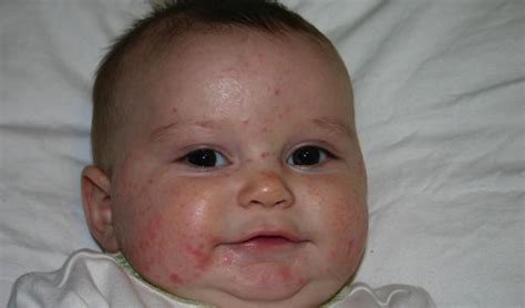 Common types of allergic reactions in infants include the following Bacteria May Be A Key To Fighting Food Allergies ...